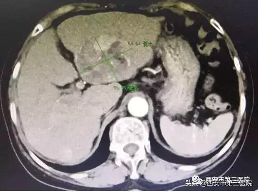 最新栓塞术，医疗革新领域的希望之光